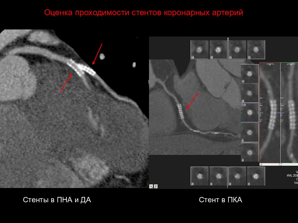 Кт скрининг коронарного кальция