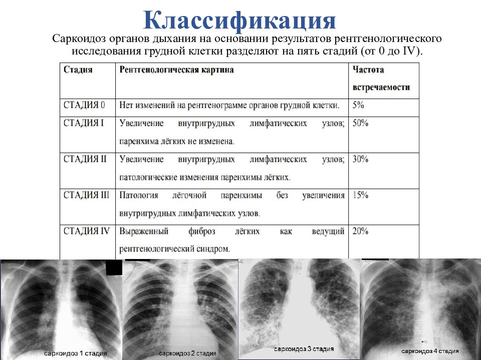 Саркоидоз клиническая картина