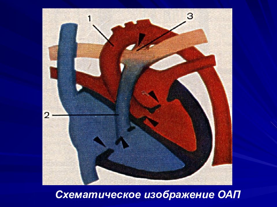 Оап у новорожденных. Открытый боталлов проток гемодинамика. Порок сердца открытый артериальный проток. Незаросший артериальный проток. Открытый аортальный порок сердца.