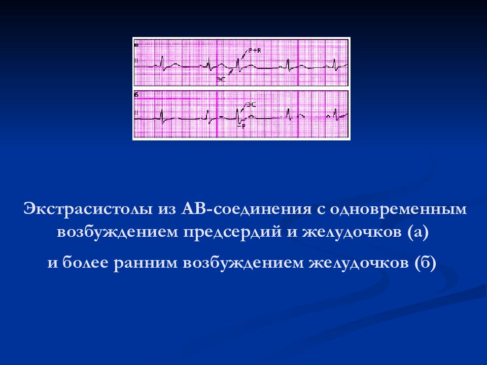 Экстрасистолы. Экстрасистолия желудочков ритм. Экстрасистолы из атриовентрикулярного соединения. Экстрасистола с одновременным возбуждением предсердий и желудочков. Экстрасистолия АВ соединения.