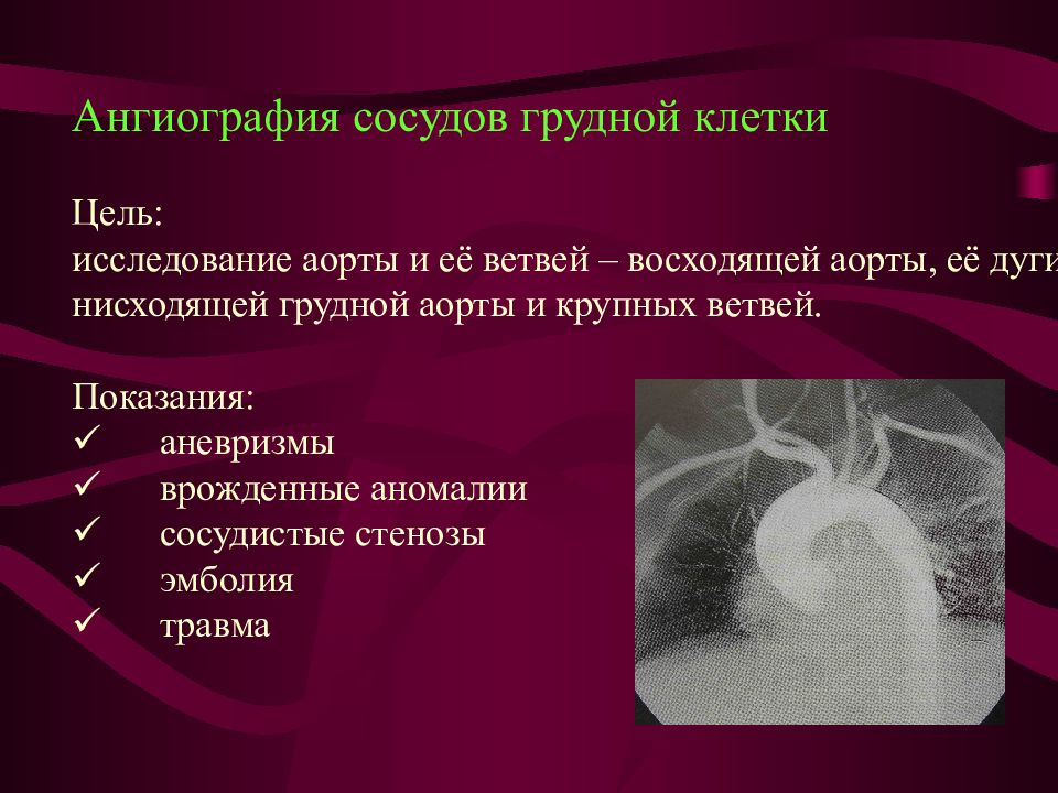 Ангиография грудной аорты. Лучевая диагностика заболеваний сердца и сосудов. Протокол ангиографии грудной аорты. Методы лучевой диагностики заболеваний сердца и сосудов.