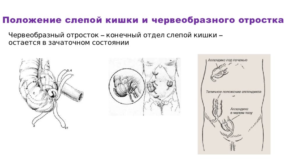 Отделы аппендикса. Атипичное расположение червеобразного отростка слепой кишка. Слепая кишка и червеобразный отросток. Голотопия червеобразного отростка. Подпеченочное положение червеобразного отростка.