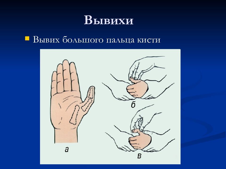 Вывихнуть. Вывих большого пальца на руке. Как вывихнуть большой палец руки.