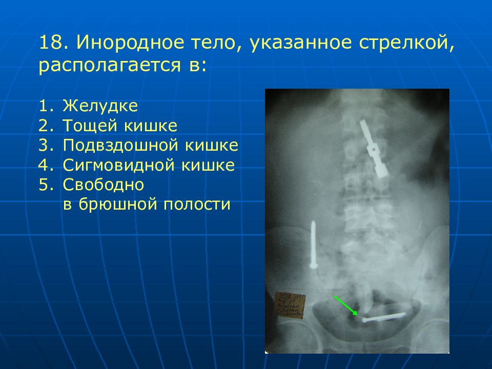 Инородное тело желудка карта вызова