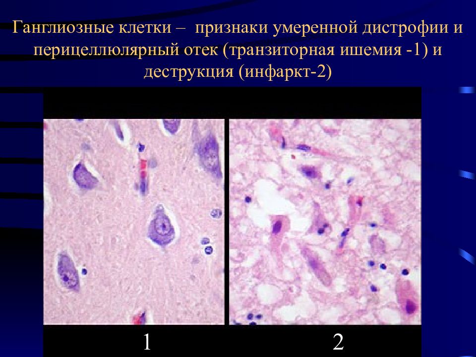 Ибс патологическая анатомия презентация