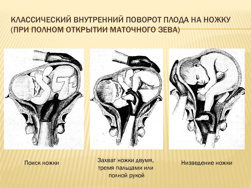 Неправильные положения плода презентация