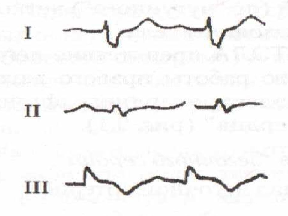 Патологическая экг