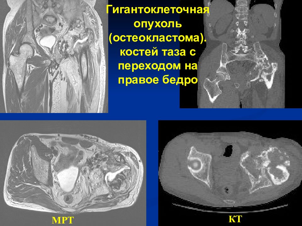 Опухоль правого. Остеосаркома костей таза кт. Фибросаркома кости мрт. Гигантоклеточная опухоль бедренной кости мрт.