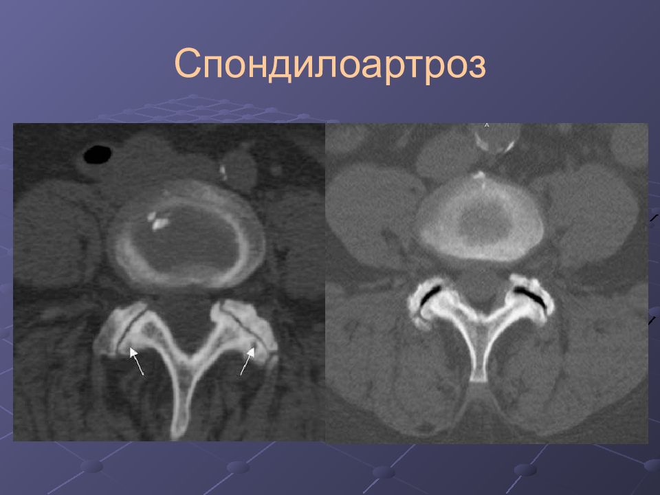 Спондилоартроз. Деформирующий спондилоартроз на кт. Спондилоартроз мрт снимок. Спондилоартроз мрт признаки. Спондилоартроз 1 степени.