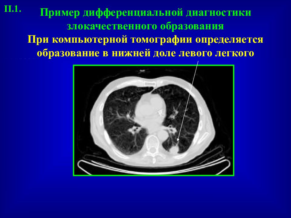 Мягкотканное образование в легком на кт. Доброкачественные образования в легких на кт.