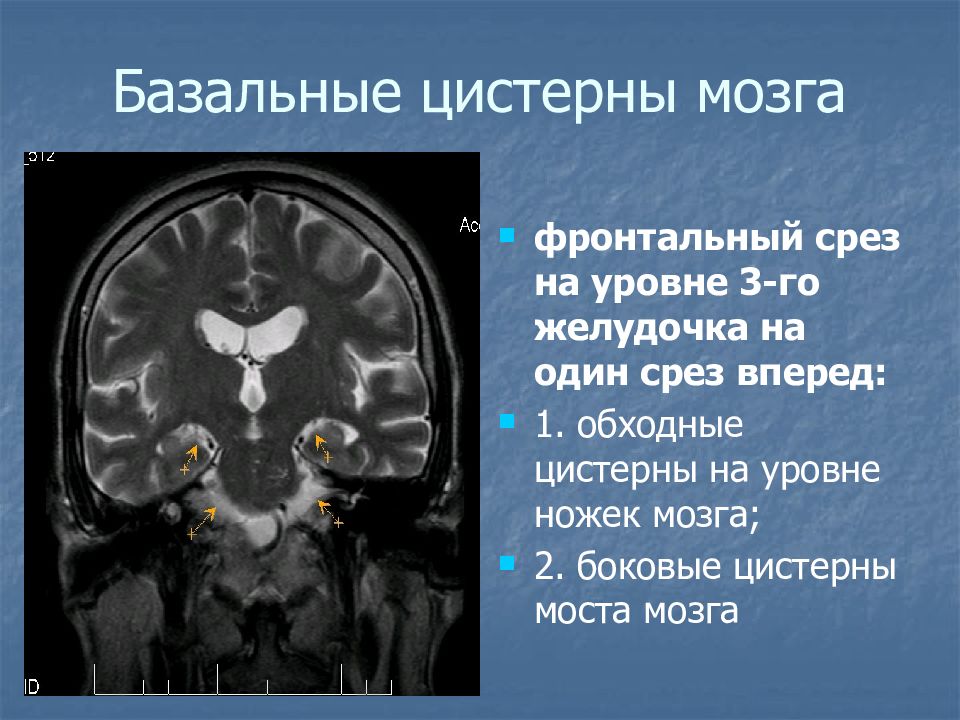 Цистерны мозга расширены