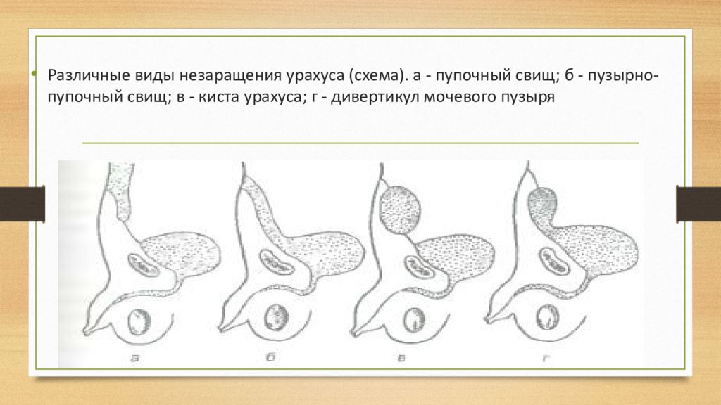 Свищ урахуса. Пузырный пупощный свищ.