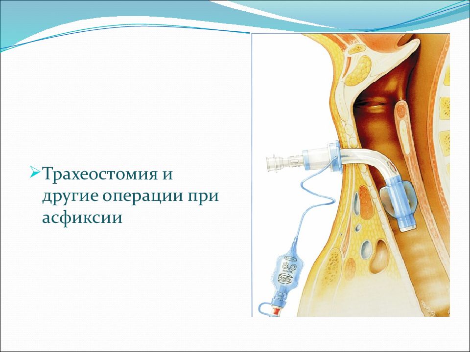 Трахеостомия. Трахеостомия топографическая анатомия. Чрескожная трахеостомия. Трахеостомия операция. Трахеостомия презентация.