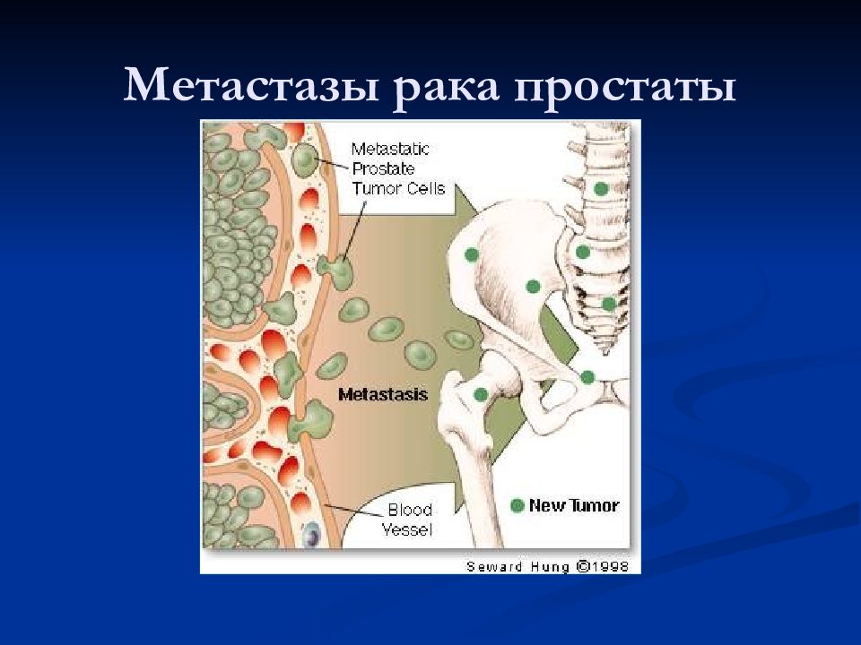Метастазы в кости при раке предстательной. Метастазирование опухолей костей. Метастазирование предстательной железы. Метастазы предстательной железы в кости.