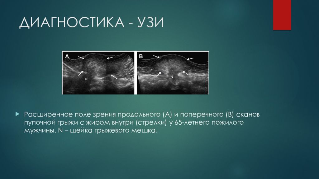 Грыжи передней брюшной стенки презентация