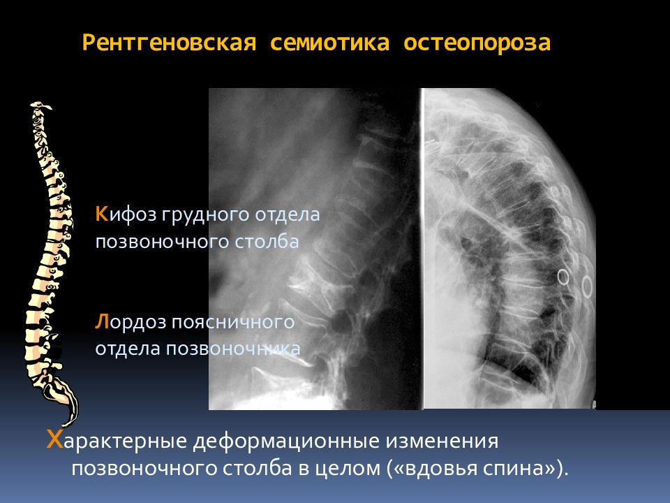 Остеопороз позвоночника. Остеопороз грудного отдела. Остеопороз грудного отдела позвоночника. Остеопороз позвоночника поясничного отдела. Остеопороз грудного отдела симптомы.