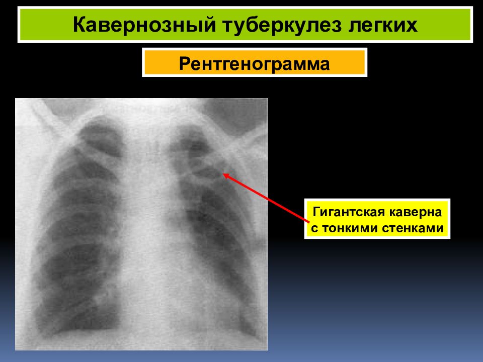 Стенка каверны при туберкулезе