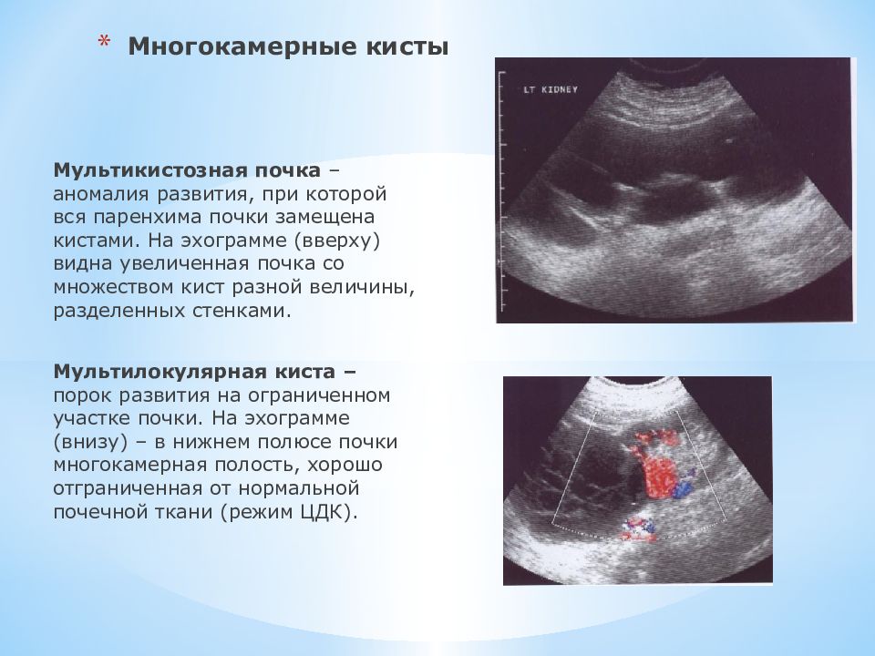 Киста почки картинка