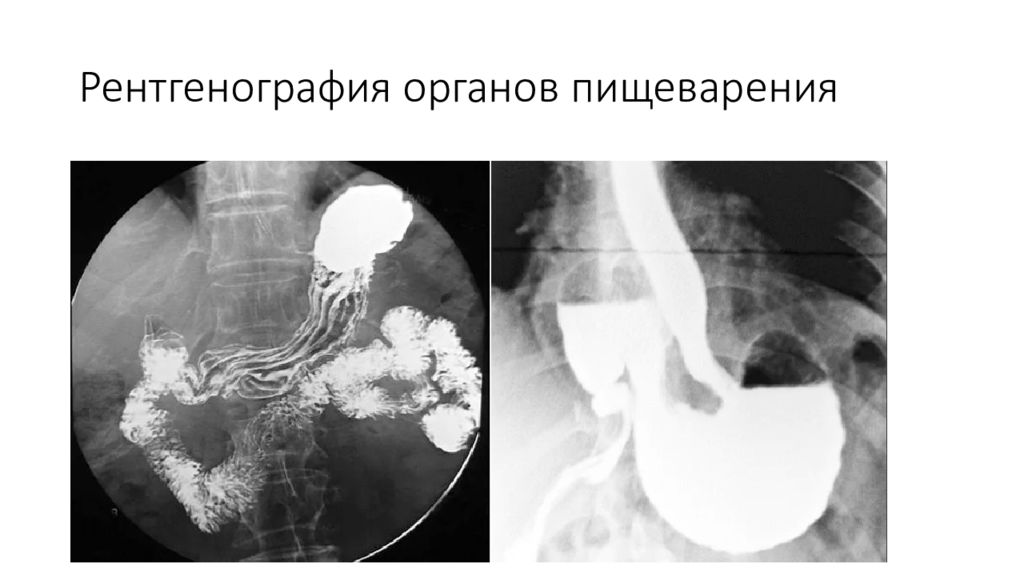 Рентгенография и рентгеноскопия