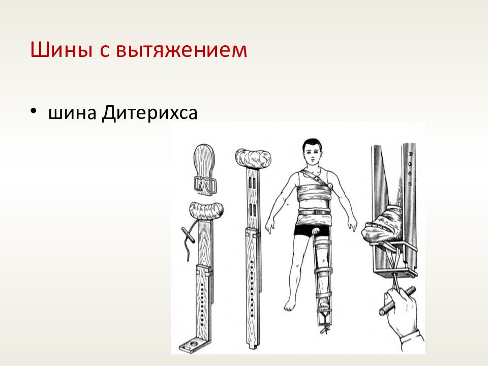 Десмургия иммобилизация. Транспортная шина Дитерихса. Наложение шины Дитерихса. Иммобилизация шиной Дитерихса. Шина Дитерихса на нижнюю конечность.