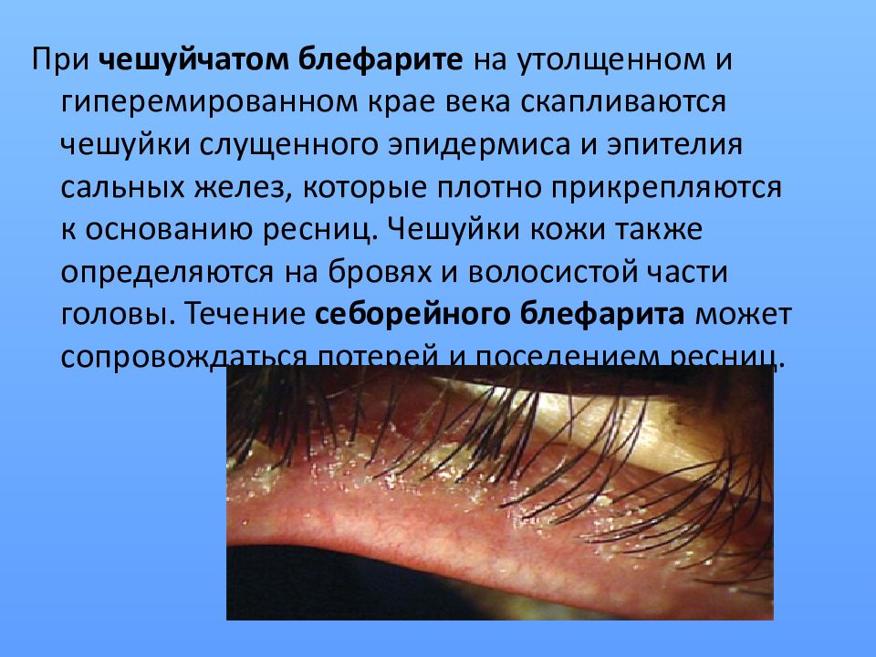 Блефарит — презентация