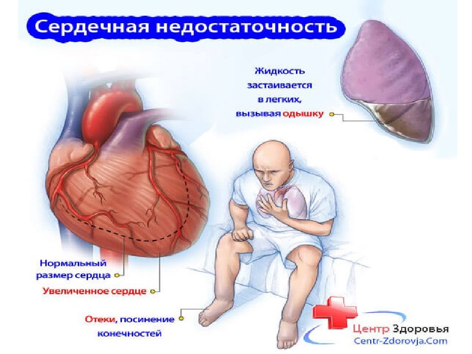 Сердечная недостаточность после. Внезапная сердечная недостаточность. Смерть от сердечной недостаточности. Сердечная недостаточность труп. Смерть от сердечной недостаточности фото.