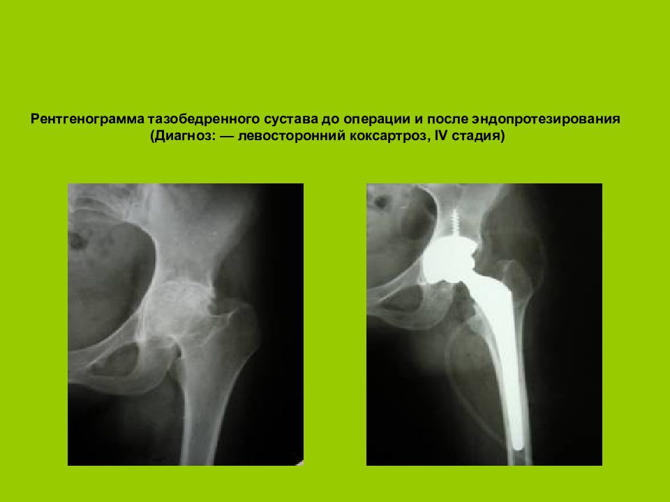 Коксартроз колена. Коксартроз эндопротезирование тазобедренного сустава. Коксартроз тазобедренного сустава операция. Эндопротезирование тазобедренного сустава этапы операции. Свищ после эндопротезирования тазобедренного сустава.