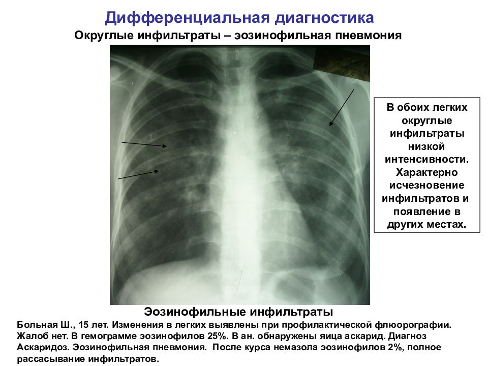 Периваскулярные изменения легочного рисунка у ребенка на рентгене