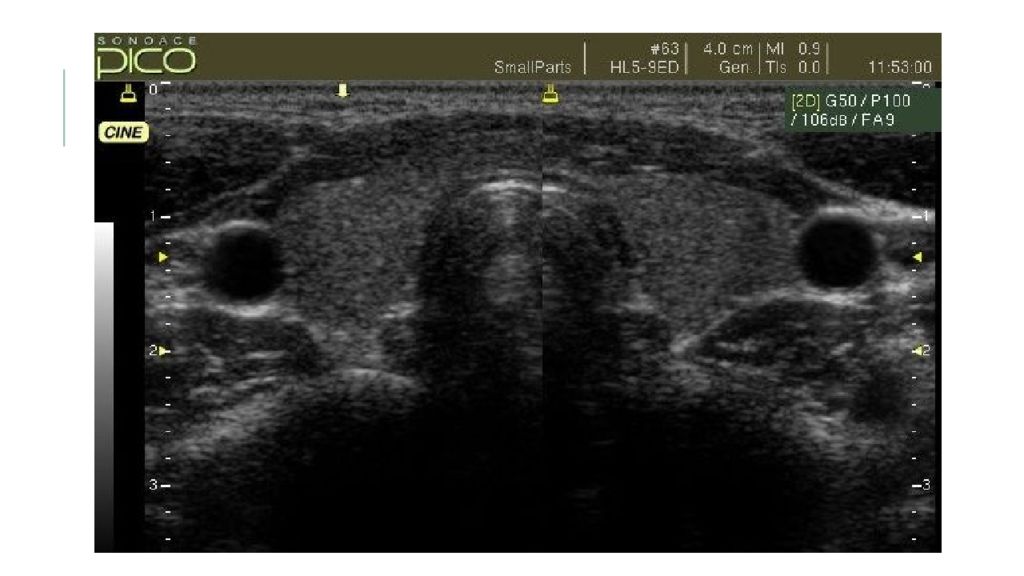 Щитовидная железа аит узи. Сонограмма щитовидной железы в норме. УЗИ картина нормальной щитовидной железы. Атлас УЗИ щитовидной железы. Узловая гиперплазия щитовидной железы сонограмма.