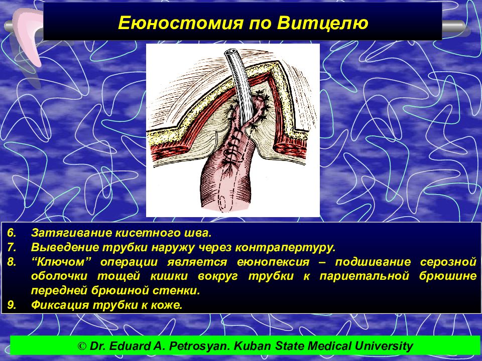 Заболевания тонкого и толстого кишечника хирургия презентация