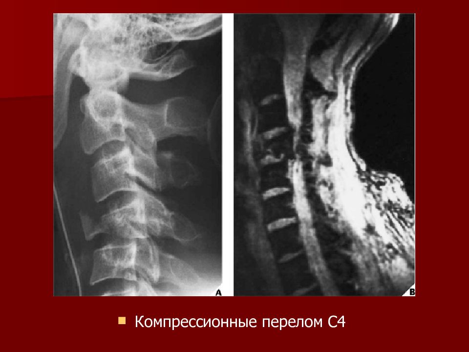 Компрессионный перелом степени. Компрессионный перелом позвоночника l12. Компрессионный перелом l1 th12. Компрессионный перелом тел l1 l2 l3. Компрессионный перелом th7-th8.