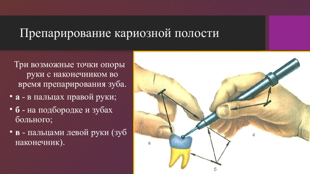 Проверить полость. Препарирование кариозных полостей. Механический инструментарий для препарирования кариозных полостей. Этапы препарирования кариозных полостей. Принципы препарирования зубов.