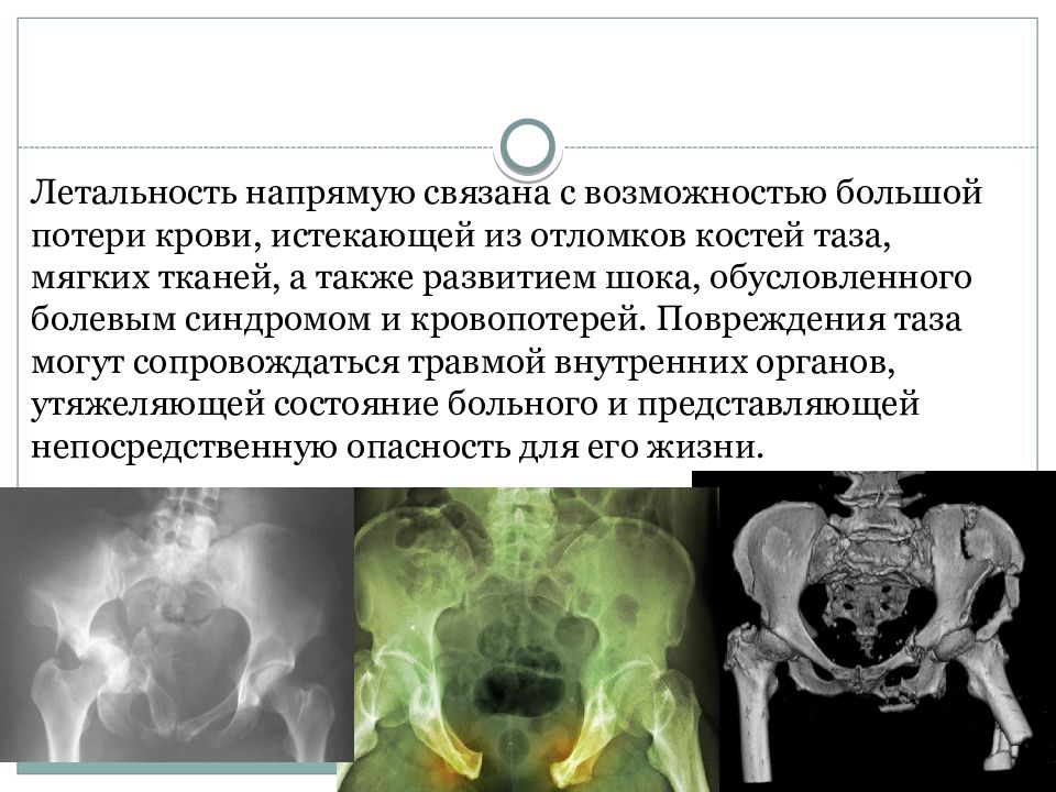 Травма таза презентация