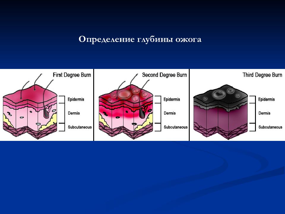 Глубина определенный. Глубина поражения ожогов. Методы определения глубины ожога. Классификация ожогов по глубине.