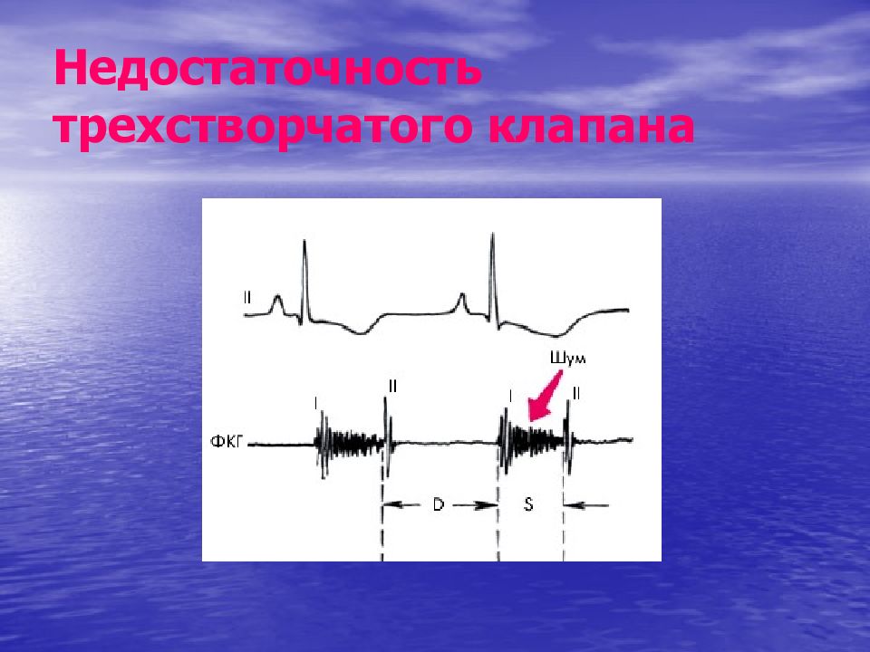 Недостаточность трехстворчатого клапана рисунок