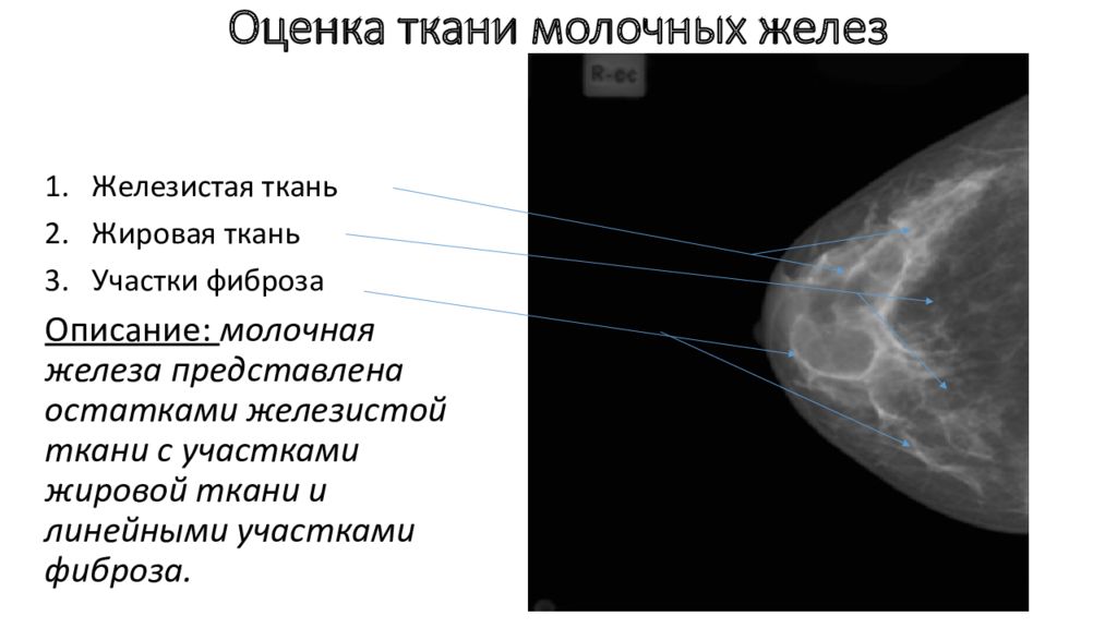 Что значит маммография. Структура молочной железы маммография. Маммография железистая ткань. Фиброзно железистая структура молочной железы. Киста молочной железы маммография заключение.