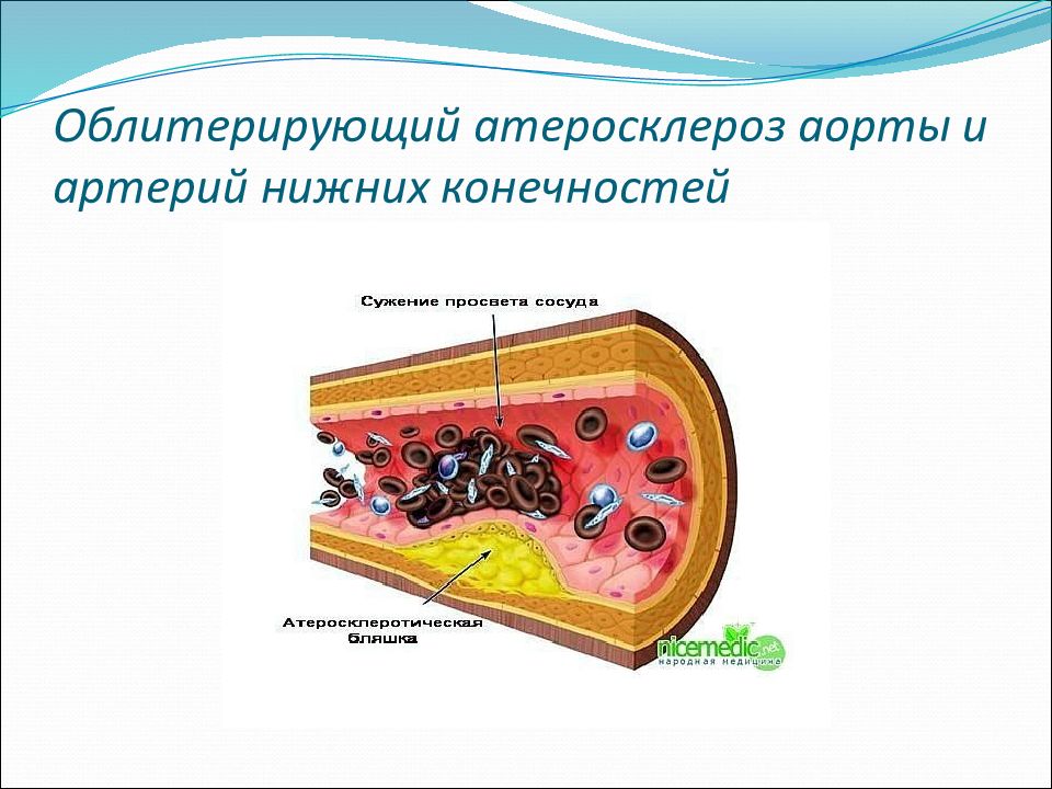 Облитерирующий атеросклероз препарат