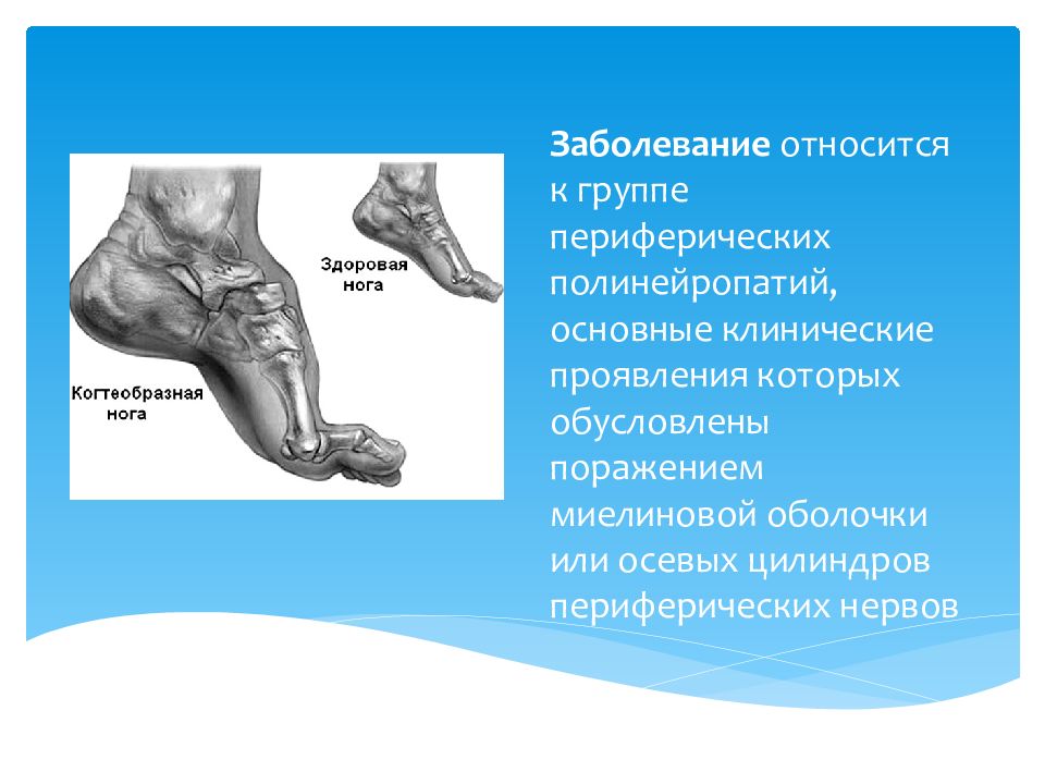 Синдром дежерина сотта презентация