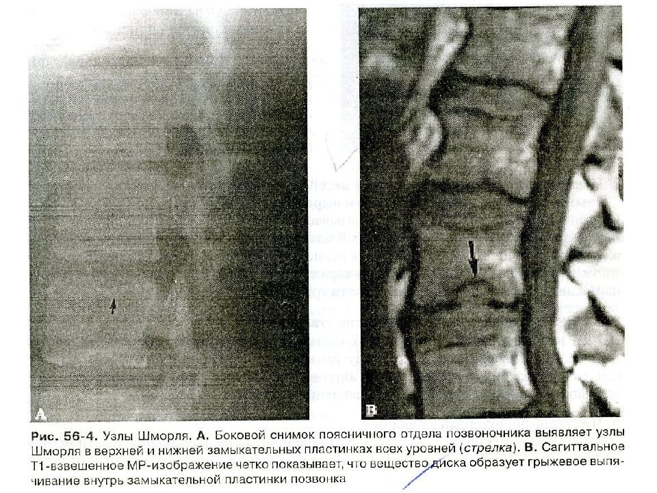 Грыжа шморля поясничного отдела. Узлы Шморля рентген. Грыжа Шморля грудного отдела на кт.