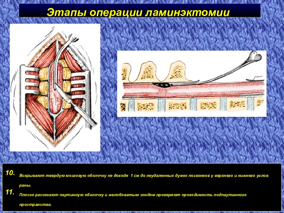 Стадии операция. Ламинэктомия позвоночника этапы операции. Операция ламинэктомия на позвоночнике. После операции на спинном мозге.