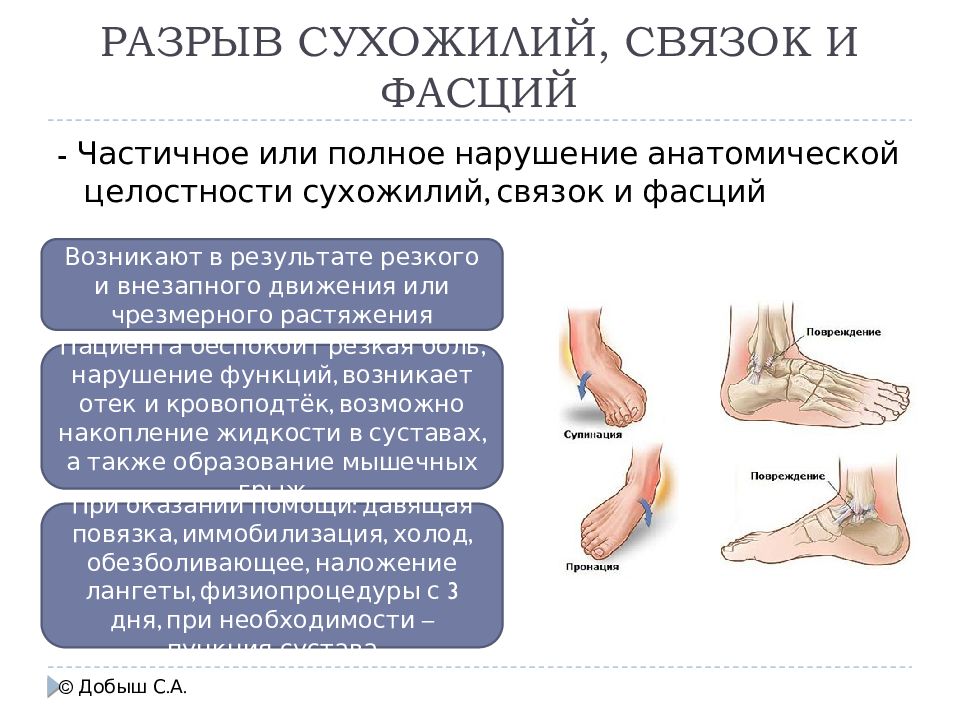 Повреждение связок. Разрыв связок и сухожилий. Растяжения и разрывы связок, сухожилий, мышц. Повреждение и разрыв связок.