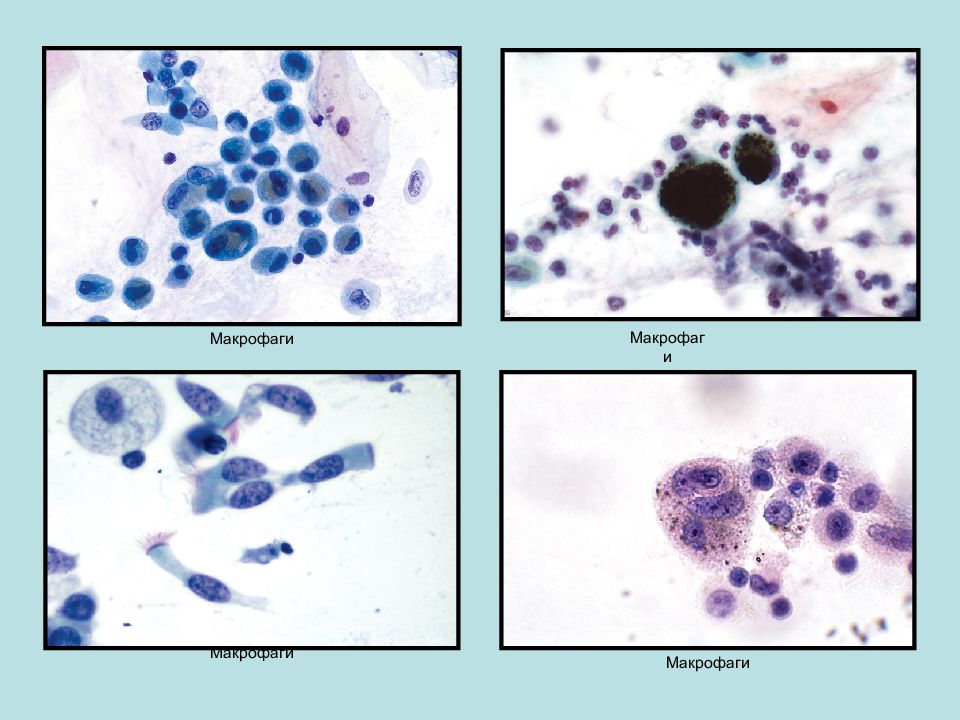 Макрофаги в мокроте фото