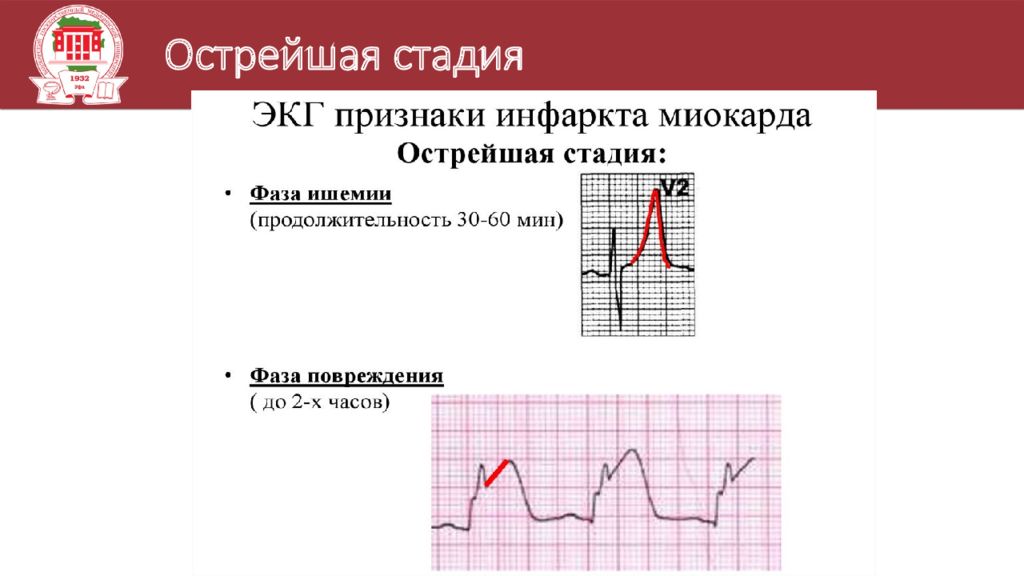 Изменения на экг. Острейшая стадия. Изменения на ЭКГ при Ковиде. Ch 0 в кардиологии. Ким тим ЭКГ изменения.