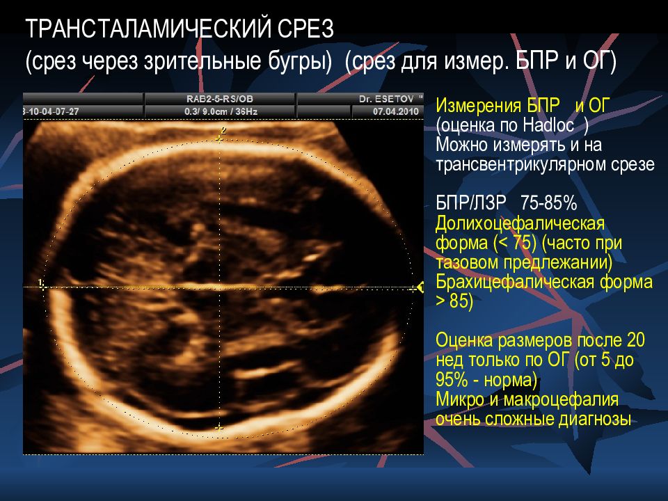 Эсетов мурад узи. Долихоцефалическая форма головы на УЗИ. Эсетов Мурад Азединович УЗИ-специалист. Долихоцефалическая форма головы у плода УЗИ. Эсетов Мурад Азединович УЗИ-специалист записаться.