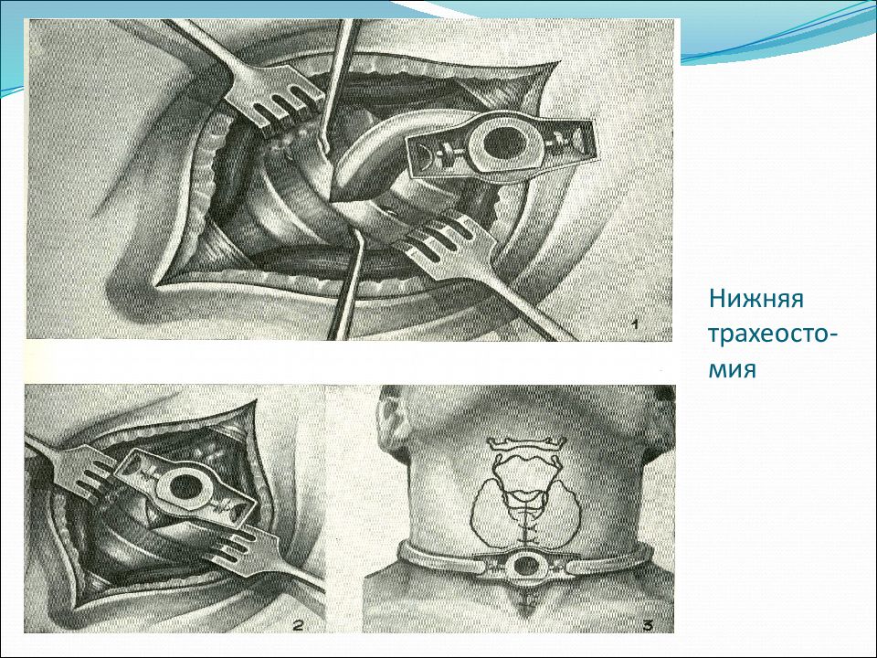 Наложение трахеостомы. Трахеостомия Оперативная хирургия. Нижняя трахеостомия топографическая анатомия. Этапы трахеостомии топографическая анатомия. Этапы верхней трахеостомии.