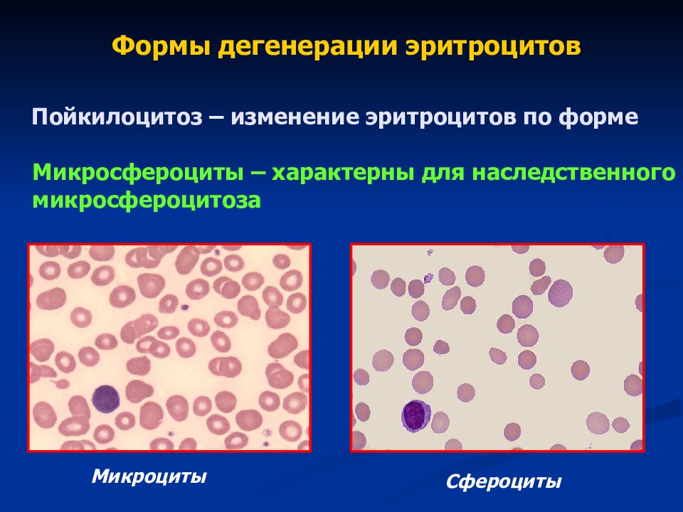 Пойкилоцитоз. Пойкилоцитоз формы. Микросфероциты. Пойкилоцитоз эритроцитов. Пойкилоцитоз эритроцитов характеризуется изменением.