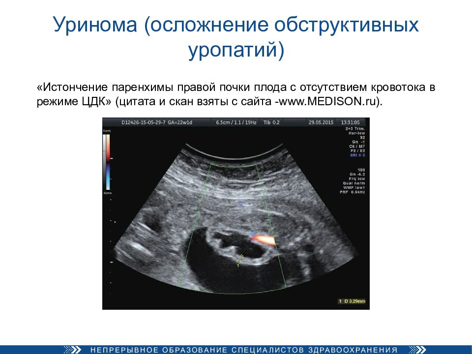 Обструктивные роды презентация