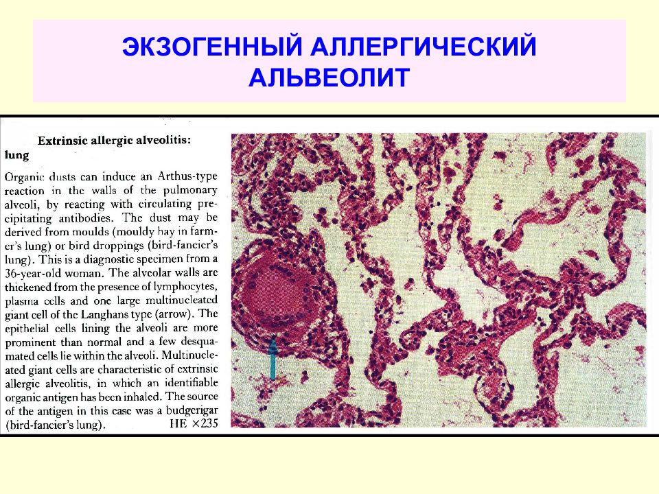 Альвеолит у детей презентация