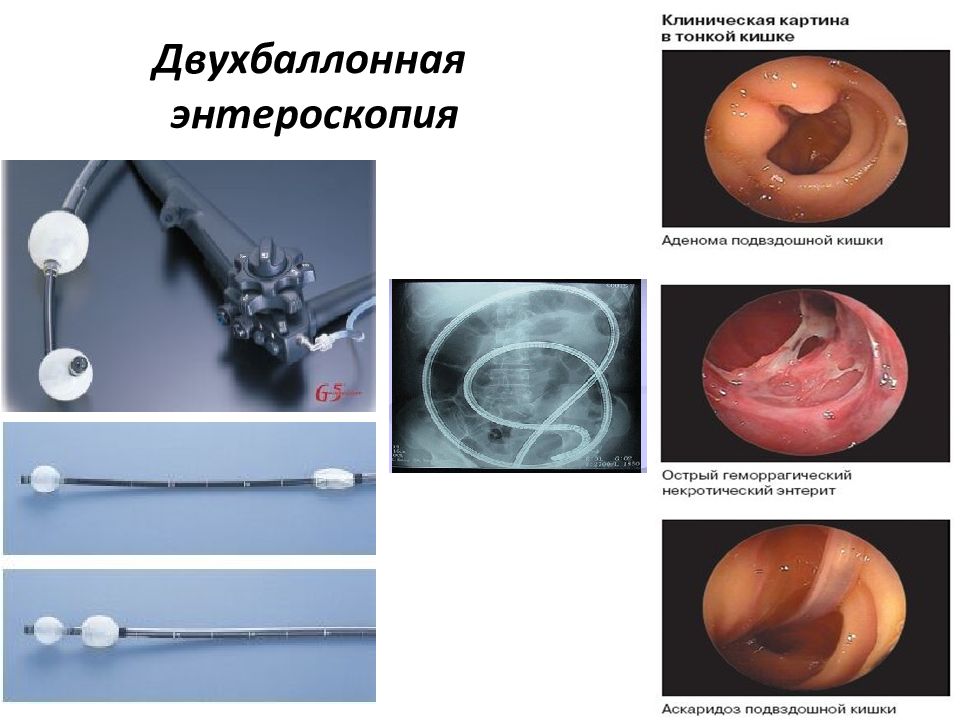 Капсульная эндоскопия презентация