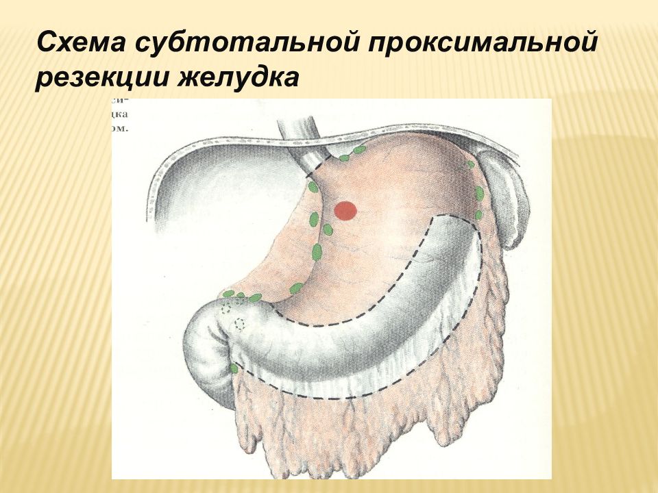 Резекция желудка отзывы. Проксимальный отдел желудка. Субтотальная опухоль желудка. Субтотальная резекция. Субтотальное поражение желудка.